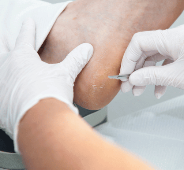 Callus and Corn Removal