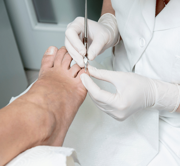 Ingrown Toenail Treatment